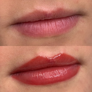 Lippenpigmentierung vorher nachher